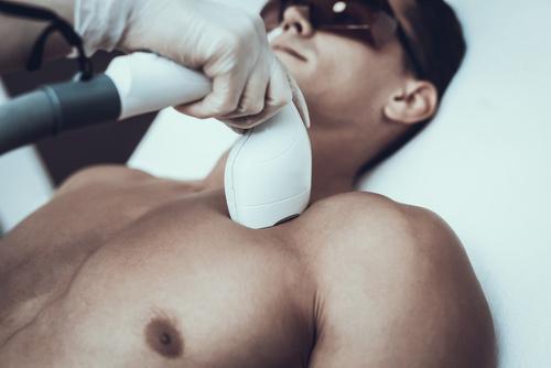 Gent’s Laser Hair Removal (Body)